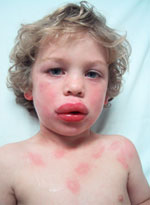 Allergic Reaction Anaphylaxis First Aid For Life