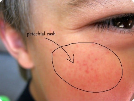 Meningitis Rash: Pictures, Symptoms, Glass Test