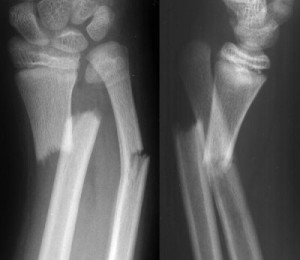open fracture