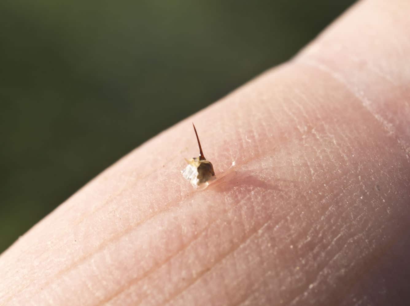 bee sting on finger treatment