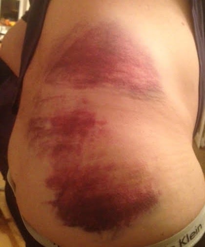 First Aid for Bumps and Bruises