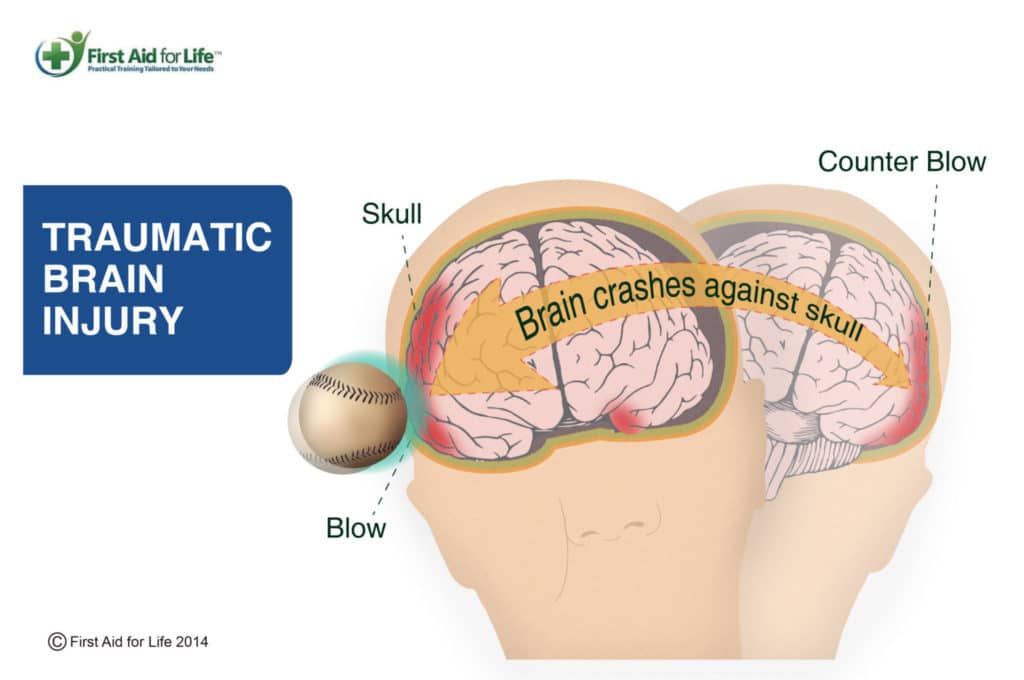 Can You Sleep After You Hit Your Head or Get a Concussion?