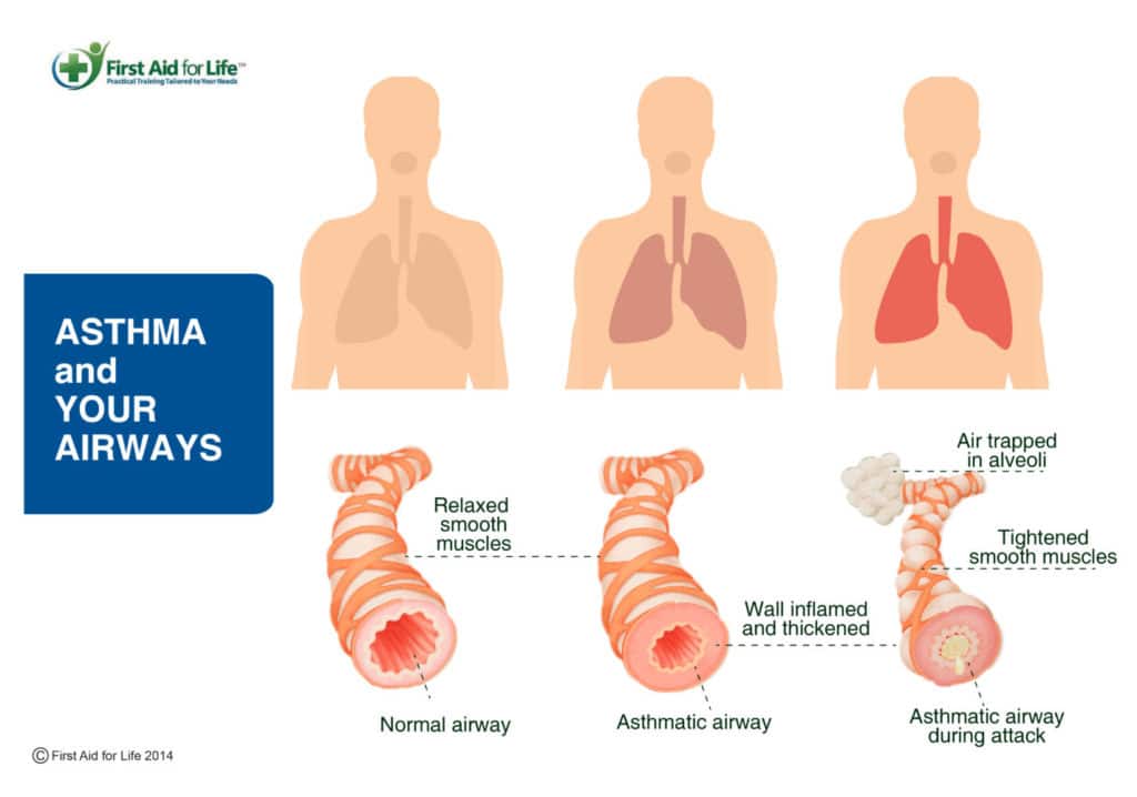 Asthma What It Is And How To Help If Someone Is Having An Asthma Attack