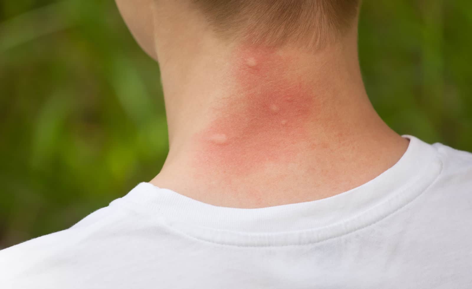 What Bit Me The Ultimate Guide To Common Bites And Stings