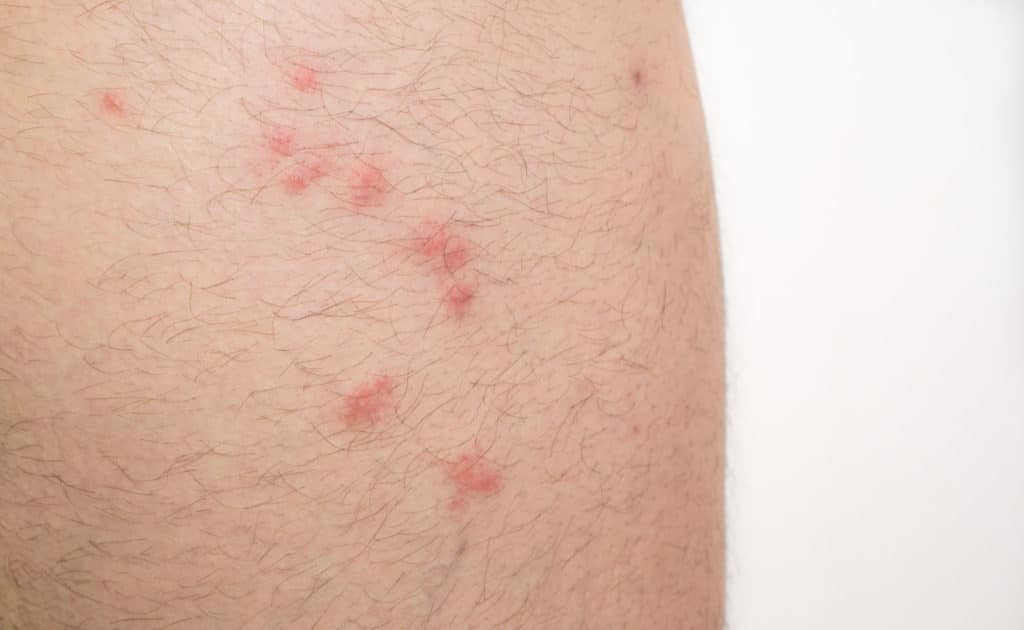 Mosquito Bites on the Skin Under the Breast Stock Photo - Image of