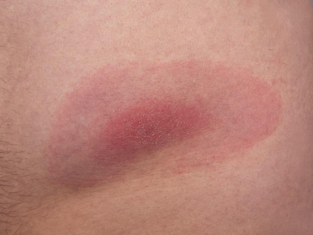 What bit me? the ultimate guide to common bites and stings