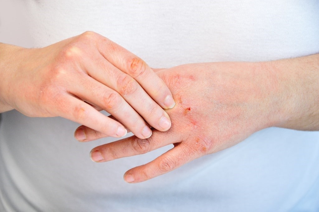 How to Avoid and Treat Dry and Chapped Hands - First Aid for Life